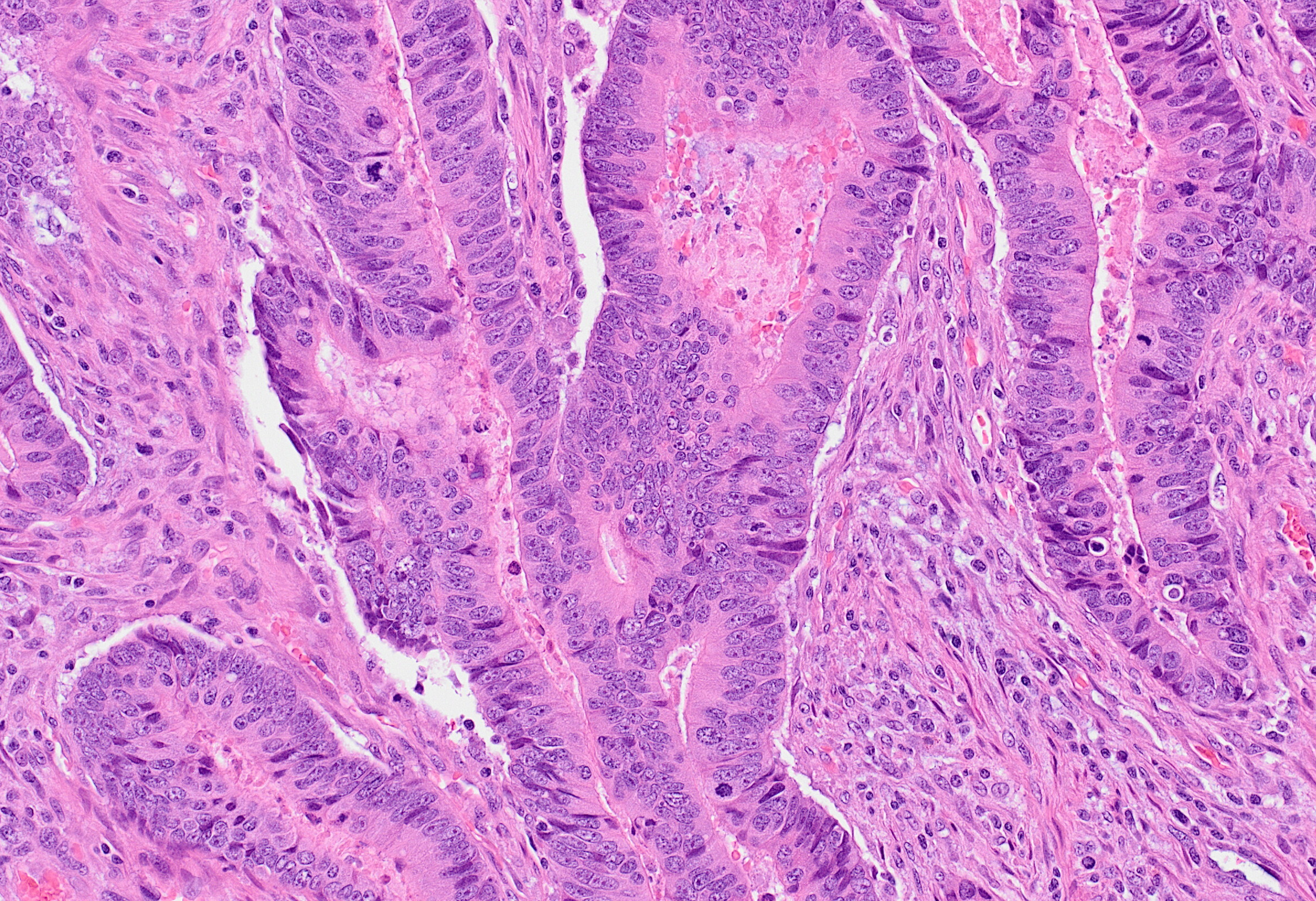 This typical colon adenocarcinoma demonstrates irregular, malignant glands set in desmoplastic stroma.